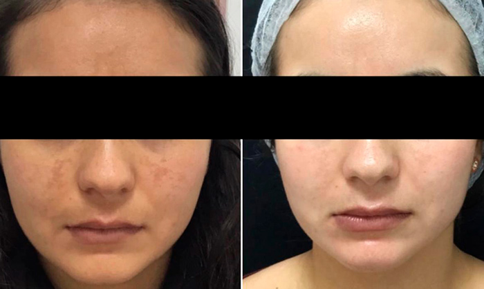 Melasma