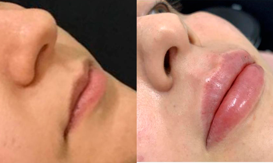 Preenchimento labial
