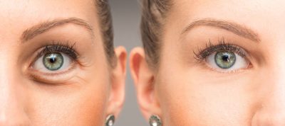 uma-jovem-mostra-os-resultados-antes-e-depois-da-cirurgia-de-blefaroplastia-bem-sucedida (1)